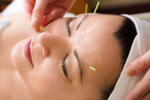 Woman receiving acupuncture on her face