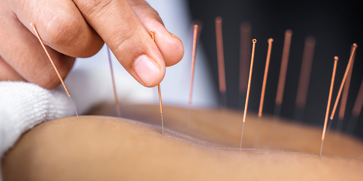 woman getting acupuncture receiving the benefits of acupuncture during addiction treatment