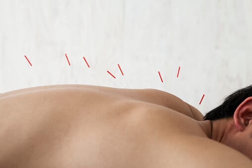 Man receiving acupuncture therapy