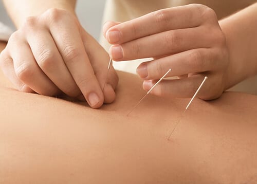what is acupuncture but thin needles placed to help with addiction